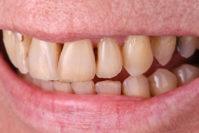 orthodontie rapide adultes Parodontite et gestion esthétique d’un déchaussement Dentiste Orangerie, Strasbourg | Esthétique & Implant