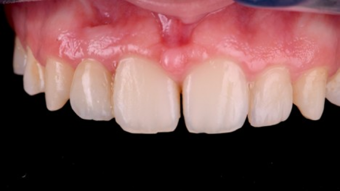 pose bridge fixe pose bridge fixe Agénésies dentaires : remplacer une dent absente dès la naissance Dentiste Orangerie, Strasbourg | Esthétique & Implant
