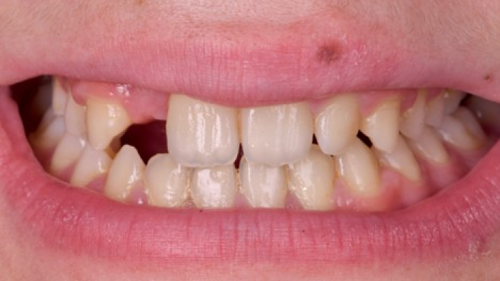 prothese complete confortable prothese complete confortable Agénésies dentaires : remplacer une dent absente dès la naissance Dentiste Orangerie, Strasbourg | Esthétique & Implant