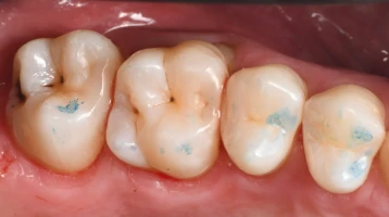 protheses sur implants protheses sur implants Caries, usure et érosion : préserver l’émail et la structure dentaire Dentiste Orangerie, Strasbourg | Esthétique & Implant
