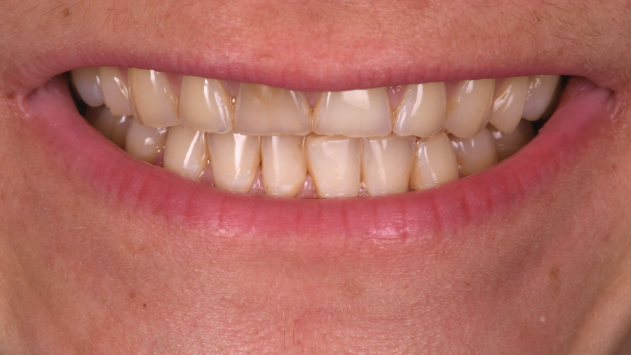 remodelage dentaire esthetique Bruxisme : une usure dentaire silencieuse et destructrice Dentiste Orangerie, Strasbourg | Esthétique & Implant