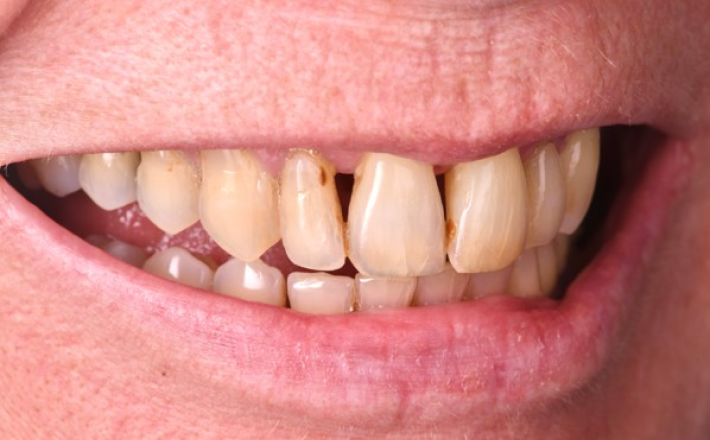 reparation dents usees Parodontite et gestion esthétique d’un déchaussement Dentiste Orangerie, Strasbourg | Esthétique & Implant