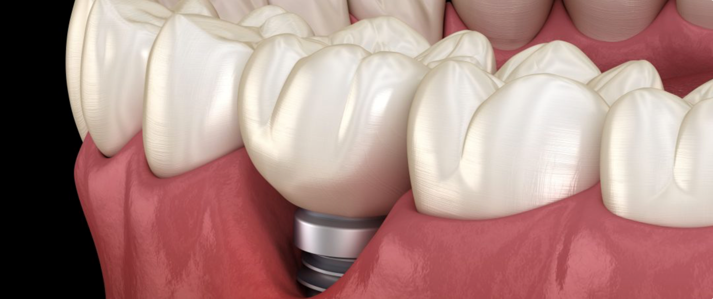 restauration dentaire esthetique Déchaussement des implants et traitement préventif : préserver la stabilité implantaire Dentiste Orangerie, Strasbourg | Esthétique & Implant