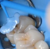 soins dentaires avances strasbourg soins dentaires avances strasbourg Caries, usure et érosion : préserver l’émail et la structure dentaire Dentiste Orangerie, Strasbourg | Esthétique & Implant