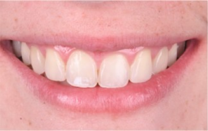 soins dentaires haut gamme soins dentaires haut gamme Agénésies dentaires : remplacer une dent absente dès la naissance Dentiste Orangerie, Strasbourg | Esthétique & Implant