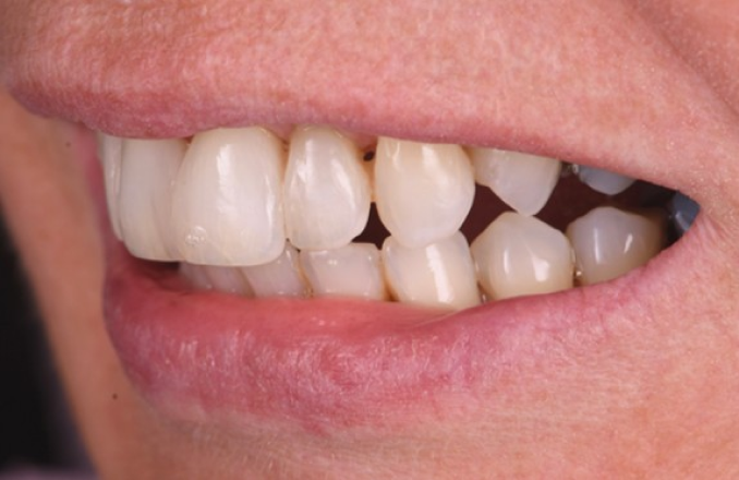 soins dentaires preventifs Parodontite et gestion esthétique d’un déchaussement Dentiste Orangerie, Strasbourg | Esthétique & Implant