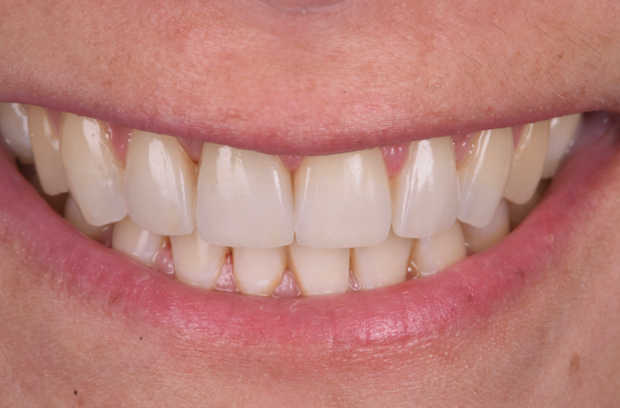 soins dentaires rapides Bruxisme : une usure dentaire silencieuse et destructrice Dentiste Orangerie, Strasbourg | Esthétique & Implant