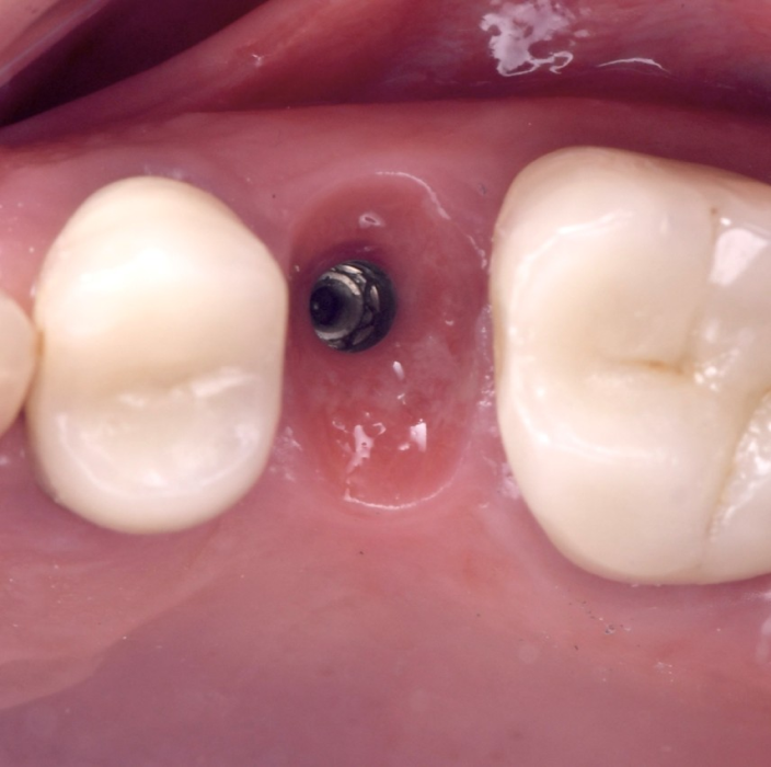 soins dentaires urgents soins dentaires urgents Maintien du volume gingival après extraction dentaire : anticiper pour un résultat optimal Dentiste Orangerie, Strasbourg | Esthétique & Implant