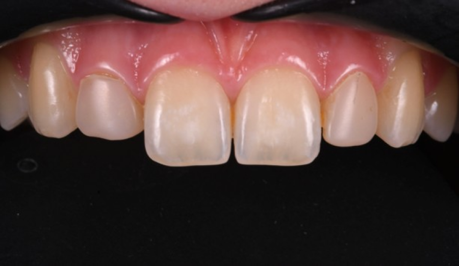 soins gencives prevention Malformations dentaires : dents en grain de riz (riziforme) et anomalies de structure Dentiste Orangerie, Strasbourg | Esthétique & Implant