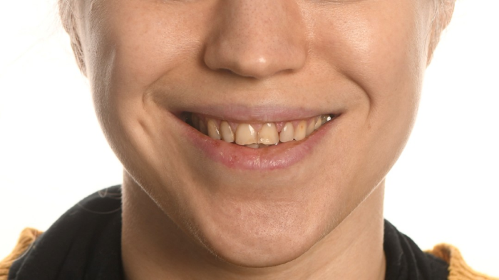 soins implantaires durables Érosion dentaire : l’effet des acides sur l’émail Dentiste Orangerie, Strasbourg | Esthétique & Implant