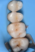 sourire harmonieux traitement orthodontique sourire harmonieux traitement orthodontique Caries, usure et érosion : préserver l’émail et la structure dentaire Dentiste Orangerie, Strasbourg | Esthétique & Implant