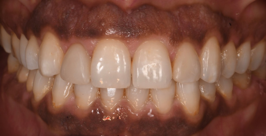 sourire hollywoodien esthetique Pigmentation ethnique : respecter la diversité, traiter si nécessaire Dentiste Orangerie, Strasbourg | Esthétique & Implant
