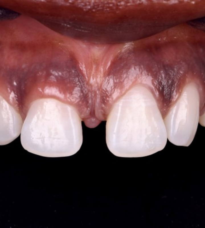 Dentiste Orangerie, Strasbourg | Esthétique & Implant taches dentaires traitement strasbourg Traitement des tâches dentaires : un sourire magnifié Dentisterie esthétique : sublimez votre sourire