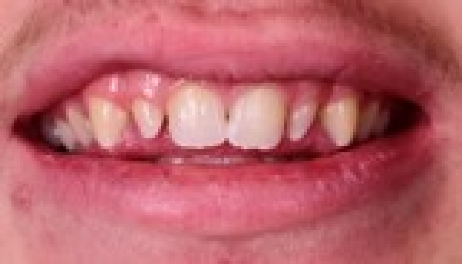 technique blanchiment avancee Malformations dentaires : dents en grain de riz (riziforme) et anomalies de structure Dentiste Orangerie, Strasbourg | Esthétique & Implant