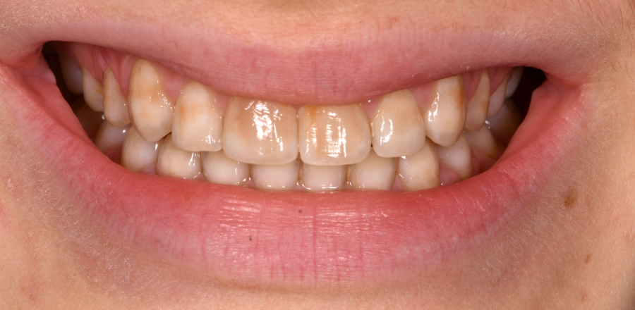 traitement blanchiment sur mesure Malformations dentaires : dents en grain de riz (riziforme) et anomalies de structure Dentiste Orangerie, Strasbourg | Esthétique & Implant