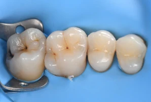 traitement carie dentaire rapide traitement carie dentaire rapide Caries, usure et érosion : préserver l’émail et la structure dentaire Dentiste Orangerie, Strasbourg | Esthétique & Implant