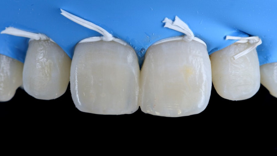 traitement couronne cassee Malpositions dentaires : les diastèmes interdentaires Dentiste Orangerie, Strasbourg | Esthétique & Implant