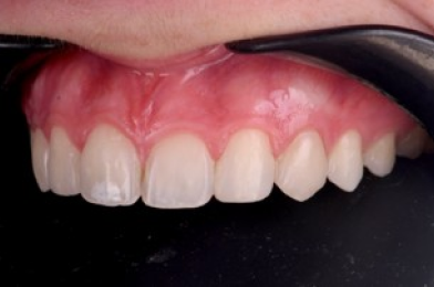 traitement dentaire minimal invasif traitement dentaire minimal invasif Agénésies dentaires : remplacer une dent absente dès la naissance Dentiste Orangerie, Strasbourg | Esthétique & Implant