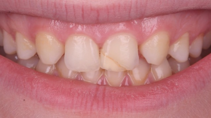 traitement fissure dentaire traitement fissure dentaire Agénésies dentaires : remplacer une dent absente dès la naissance Dentiste Orangerie, Strasbourg | Esthétique & Implant