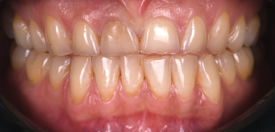 traitement gencives laser 1 Bruxisme : une usure dentaire silencieuse et destructrice Dentiste Orangerie, Strasbourg | Esthétique & Implant