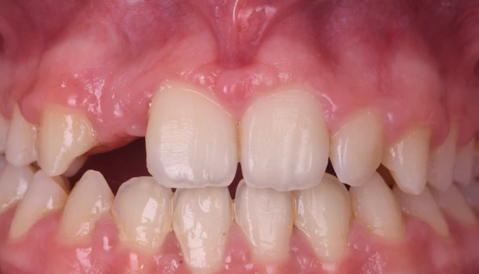 traitement parodontal laser traitement parodontal laser Agénésies dentaires : remplacer une dent absente dès la naissance Dentiste Orangerie, Strasbourg | Esthétique & Implant