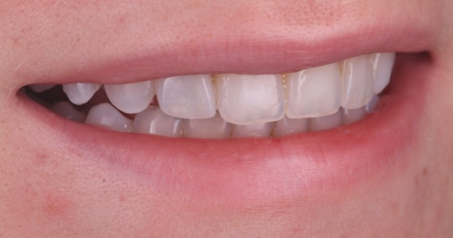traitement retraction gencives Malformations dentaires : dents en grain de riz (riziforme) et anomalies de structure Dentiste Orangerie, Strasbourg | Esthétique & Implant