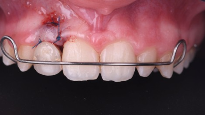 traitement souplesse mandibulaire traitement souplesse mandibulaire Agénésies dentaires : remplacer une dent absente dès la naissance Dentiste Orangerie, Strasbourg | Esthétique & Implant
