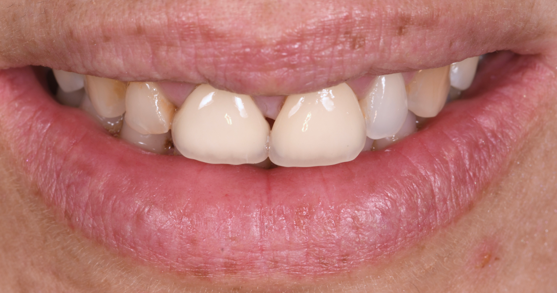 Dentiste Orangerie, Strasbourg | Esthétique & Implant taches dentaires traitement strasbourg Traitement des tâches dentaires : un sourire magnifié Dentisterie esthétique : sublimez votre sourire