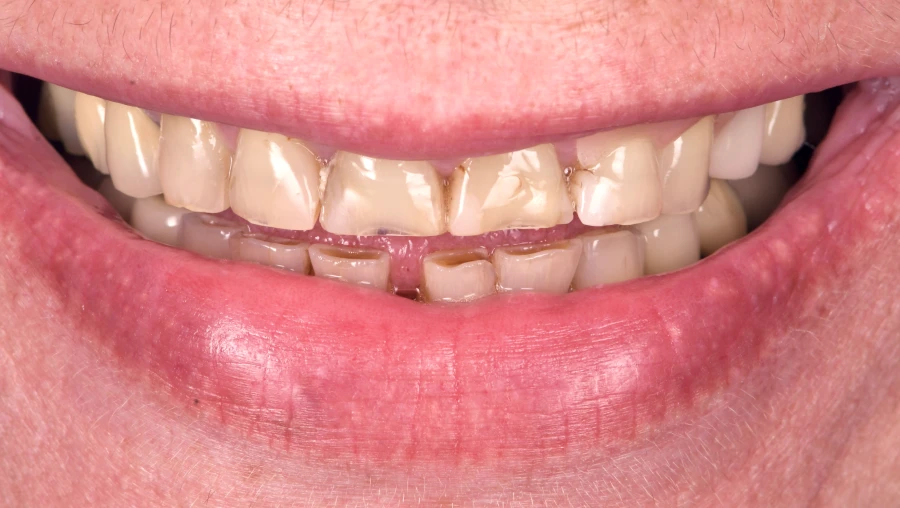 blanchiment-dentaire-sourire-eclatant