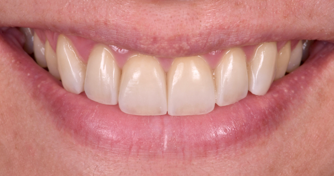 blanchiment sourire naturel Bruxisme Dentiste Orangerie, Strasbourg | Esthétique & Implant