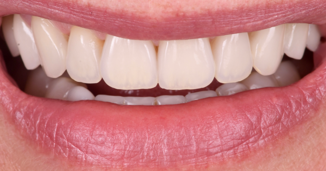 Dentiste Orangerie, Strasbourg | Esthétique & Implant taches dentaires traitement strasbourg Traitement des tâches dentaires : un sourire magnifié Dentisterie esthétique : sublimez votre sourire