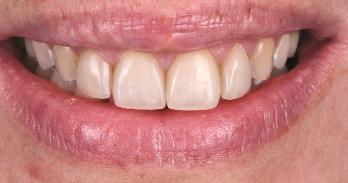chirurgie gingivale esthetique Reconstruction Dentiste Orangerie, Strasbourg | Esthétique & Implant