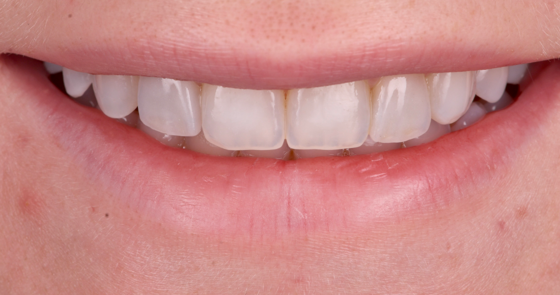 Dentiste Orangerie, Strasbourg | Esthétique & Implant taches dentaires traitement strasbourg Traitement des tâches dentaires : un sourire magnifié Dentisterie esthétique : sublimez votre sourire