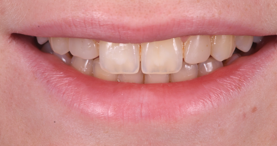 Dentiste Orangerie, Strasbourg | Esthétique & Implant taches dentaires traitement strasbourg Traitement des tâches dentaires : un sourire magnifié Dentisterie esthétique : sublimez votre sourire