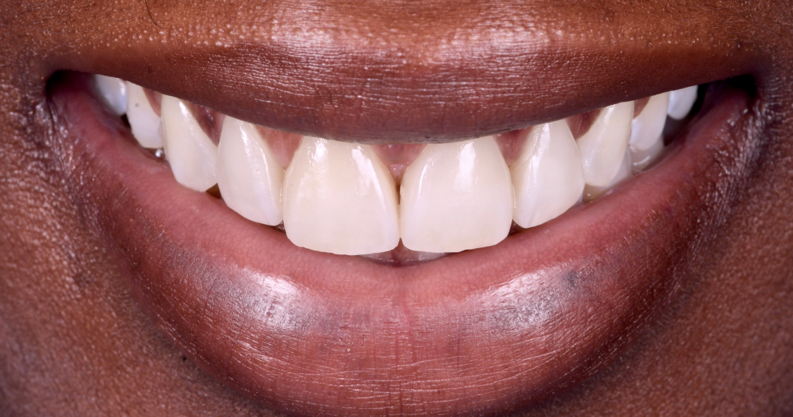 facette dentaire sur mesure Diastème Dentiste Orangerie, Strasbourg | Esthétique & Implant