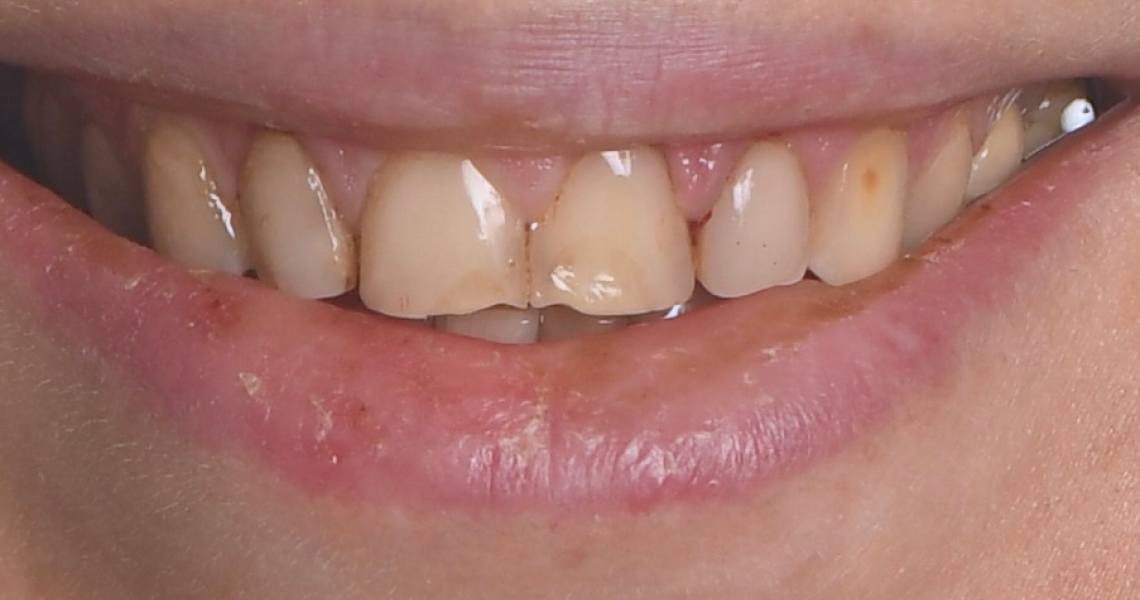 Dentiste Orangerie, Strasbourg | Esthétique & Implant taches dentaires traitement strasbourg Traitement des tâches dentaires : un sourire magnifié Dentisterie esthétique : sublimez votre sourire