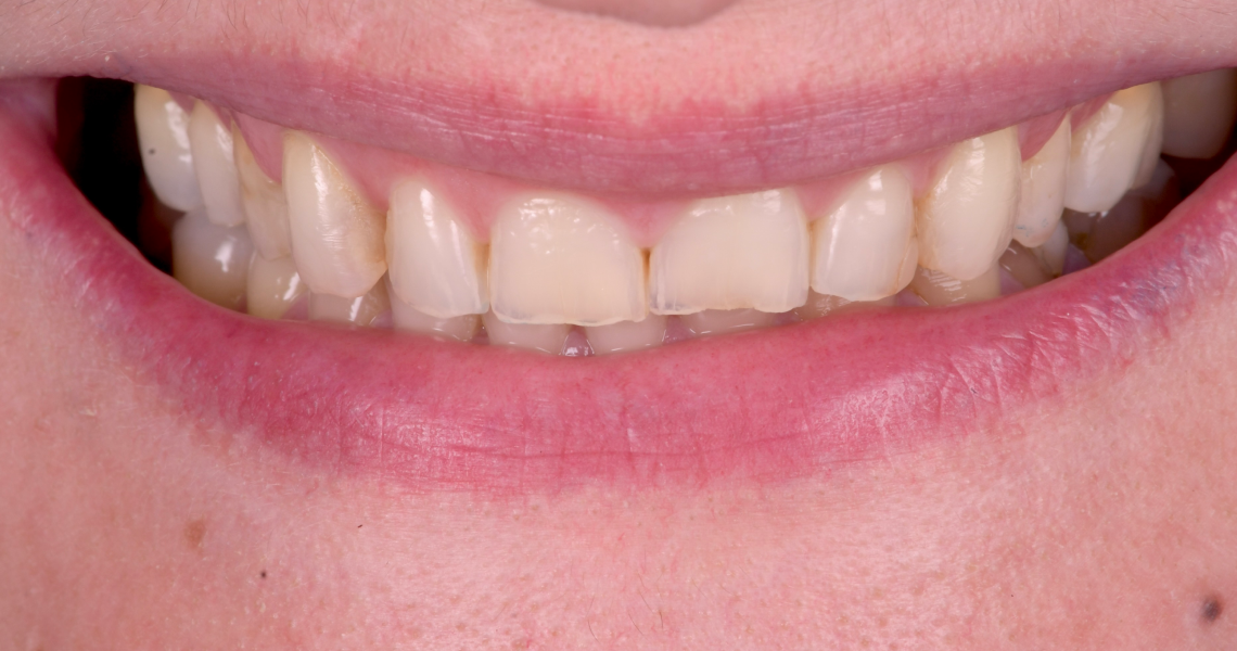 orthodontie-adultes-alignement-dents