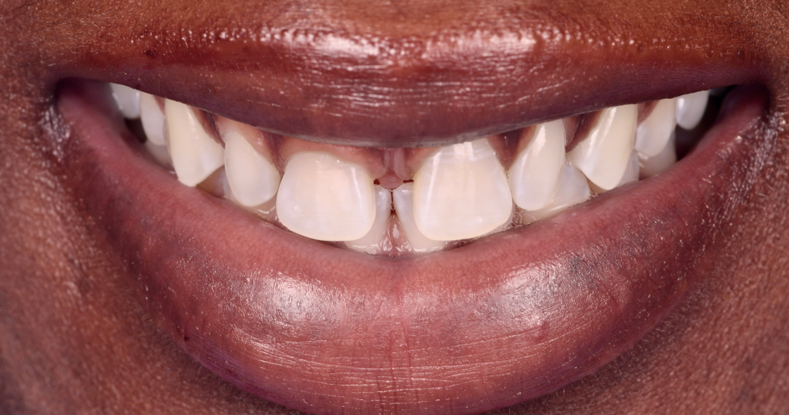 Dentiste Orangerie, Strasbourg | Esthétique & Implant taches dentaires traitement strasbourg Traitement des tâches dentaires : un sourire magnifié Dentisterie esthétique : sublimez votre sourire