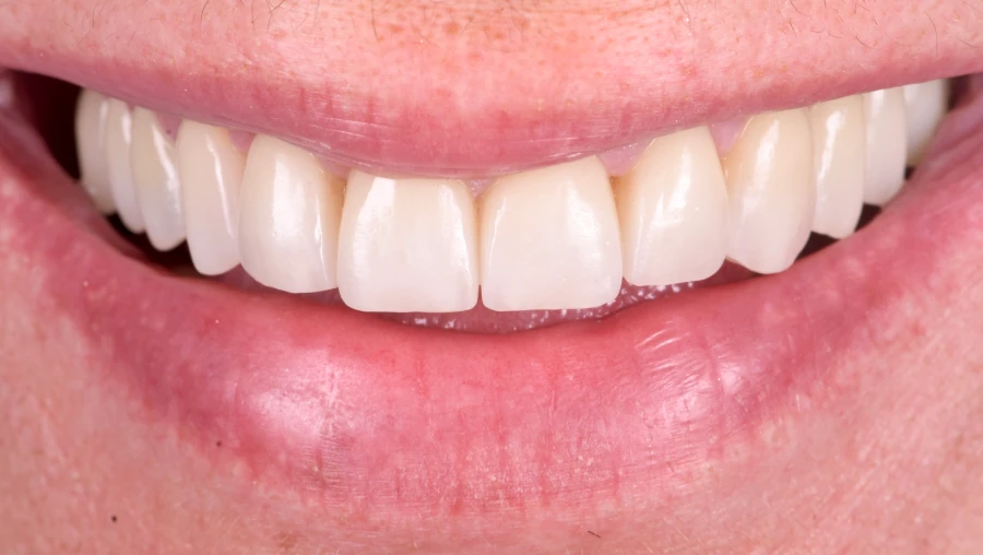 orthodontie reequilibrer aligner sourire Esthétique Dentiste Orangerie, Strasbourg | Esthétique & Implant