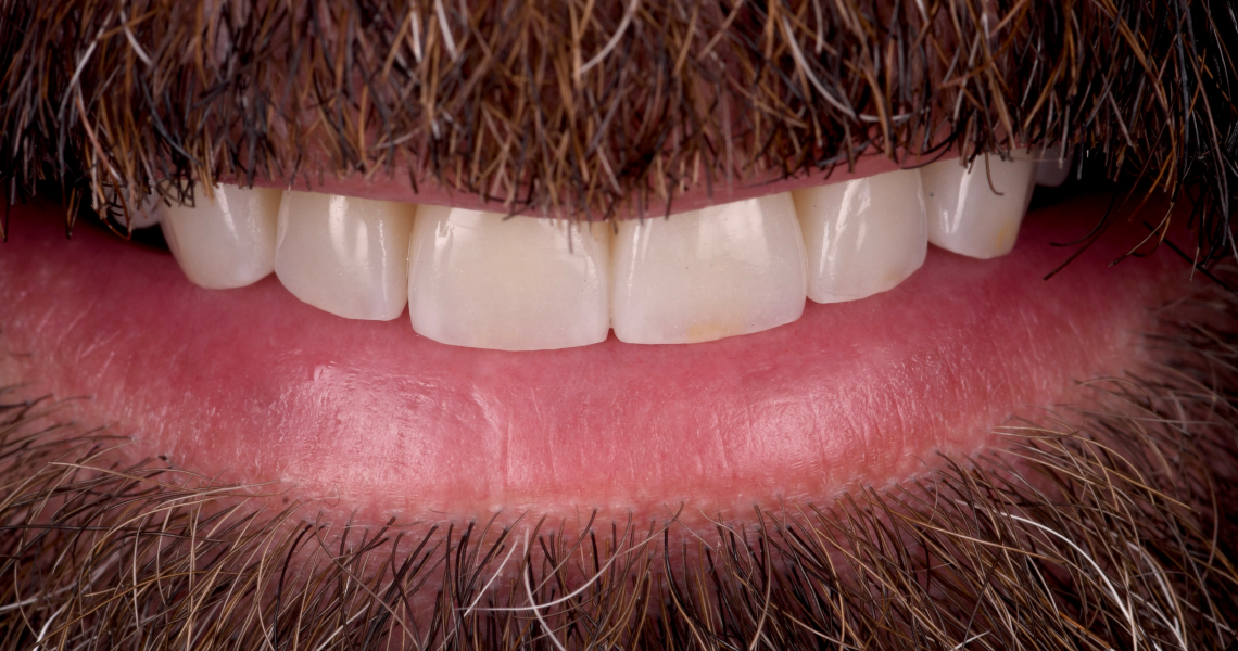 pose implants sans douleur Bruxisme Dentiste Orangerie, Strasbourg | Esthétique & Implant