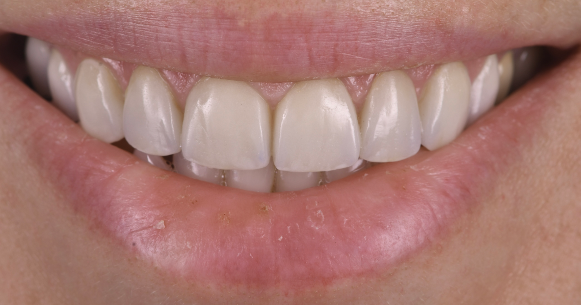 Dentiste Orangerie, Strasbourg | Esthétique & Implant taches dentaires traitement strasbourg Traitement des tâches dentaires : un sourire magnifié Dentisterie esthétique : sublimez votre sourire