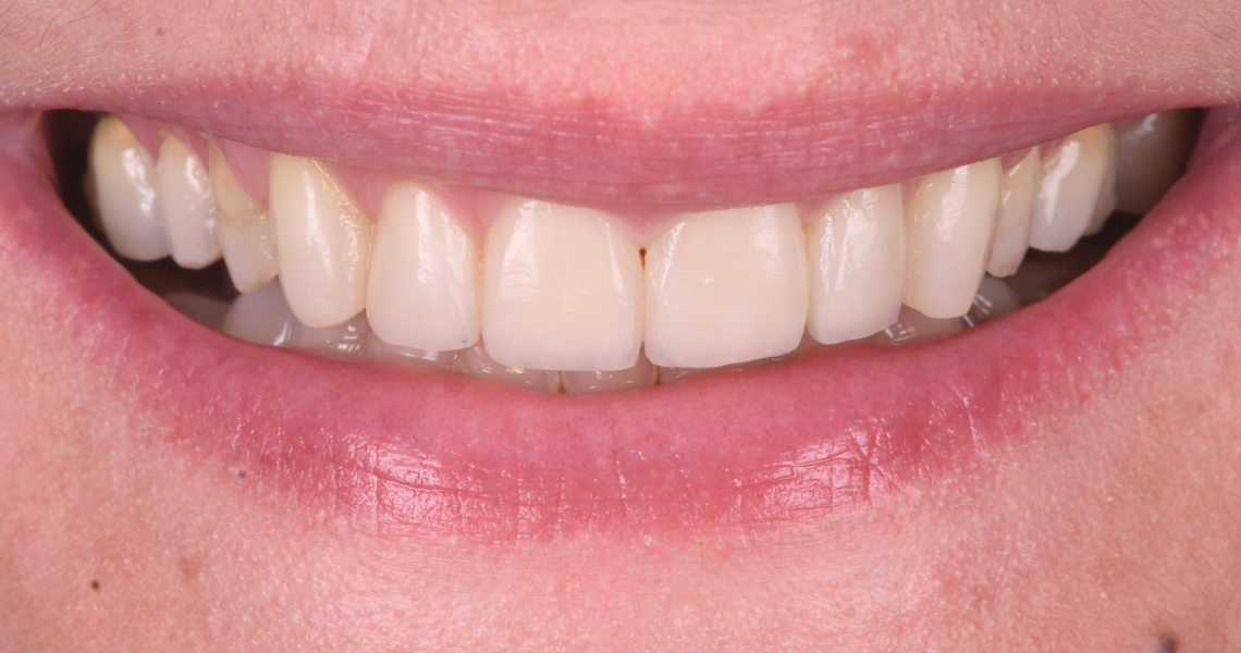 Dentiste Orangerie, Strasbourg | Esthétique & Implant taches dentaires traitement strasbourg Traitement des tâches dentaires : un sourire magnifié Dentisterie esthétique : sublimez votre sourire