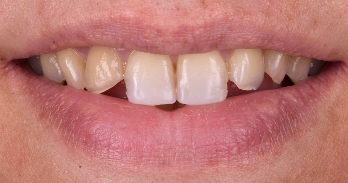 Dentiste Orangerie, Strasbourg | Esthétique & Implant taches dentaires traitement strasbourg Traitement des tâches dentaires : un sourire magnifié Dentisterie esthétique : sublimez votre sourire