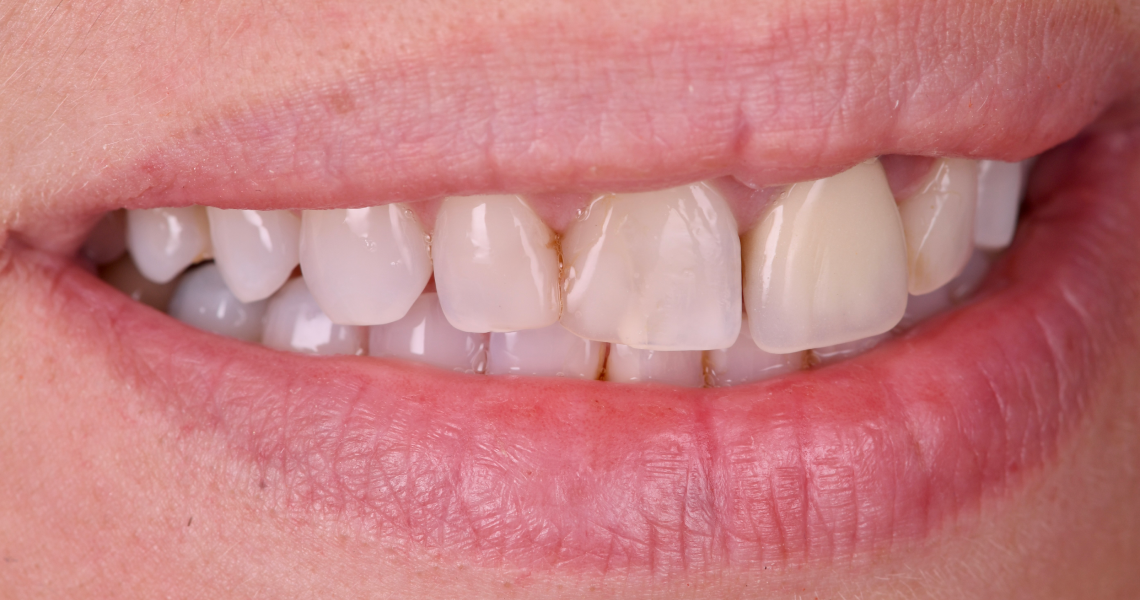 Dentiste Orangerie, Strasbourg | Esthétique & Implant taches dentaires traitement strasbourg Traitement des tâches dentaires : un sourire magnifié Dentisterie esthétique : sublimez votre sourire