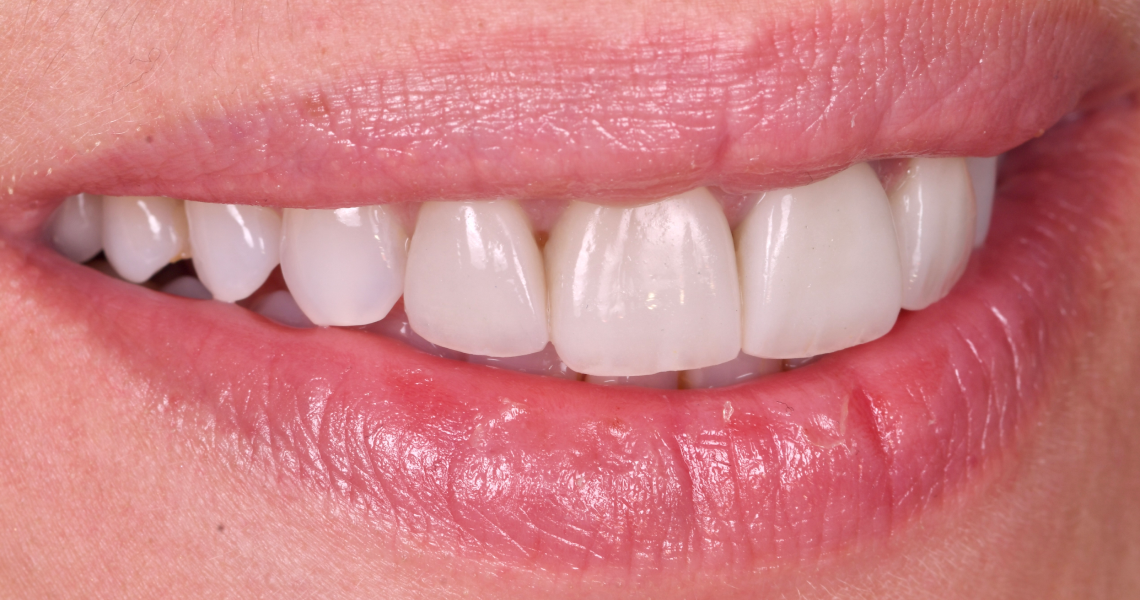 Dentiste Orangerie, Strasbourg | Esthétique & Implant taches dentaires traitement strasbourg Traitement des tâches dentaires : un sourire magnifié Dentisterie esthétique : sublimez votre sourire