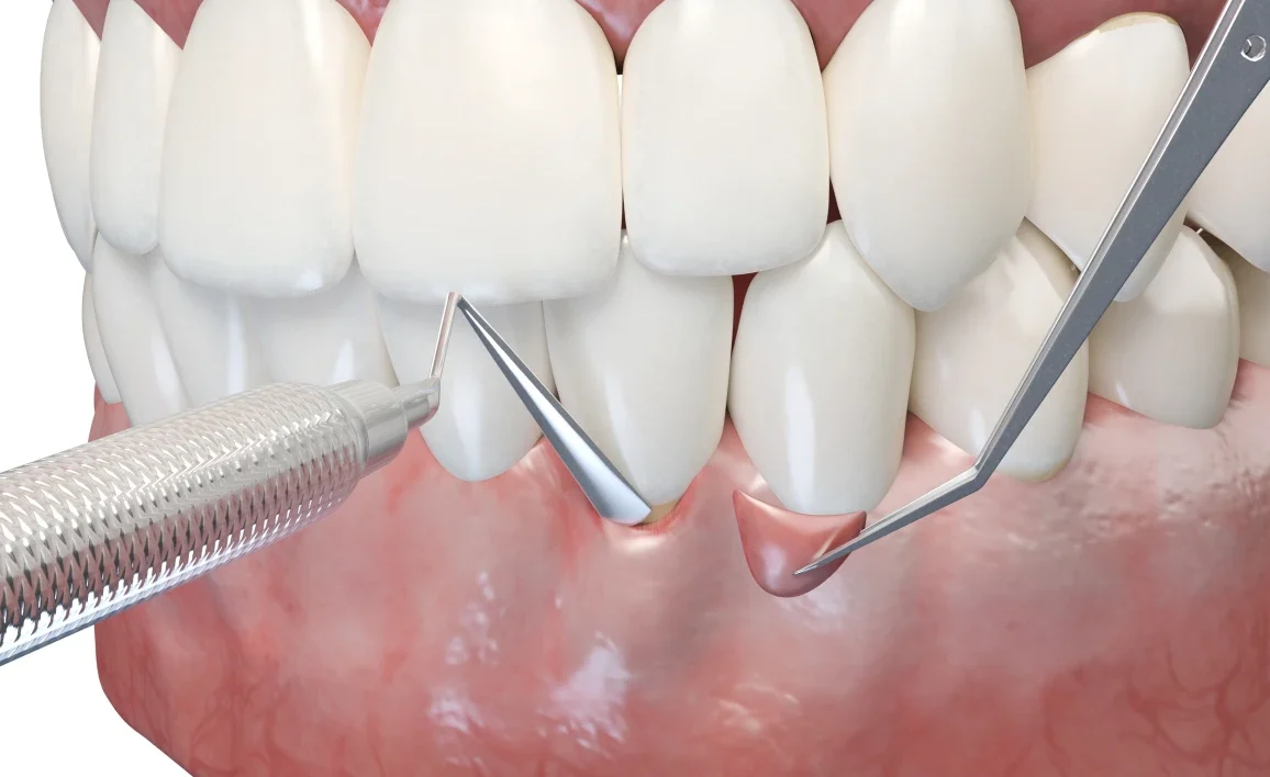 greffe gingivale procedure e1753109111693 Consignes après une greffe de gencive / chirurgie mucogingivale Dentiste Orangerie, Strasbourg | Esthétique & Implant